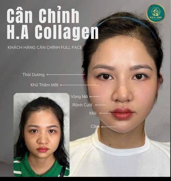 Cân chỉnh HA Collagen full face tại Hoa Anh — ca 1